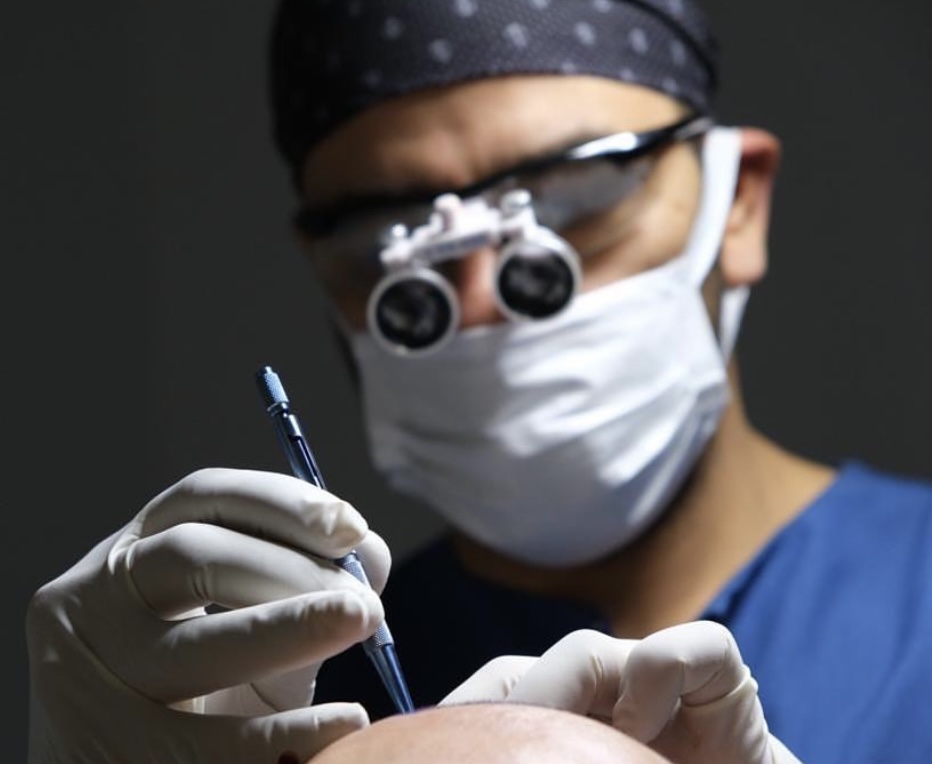 Close-up van een arts die met een implanter pen haarwortels plaatst